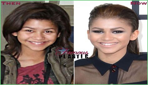 Unveiling The Secrets Of Zendaya's Nose Job: Discoveries And Insights